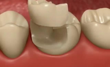 Illustrazione protesi intarsi