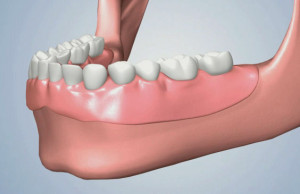 Illustrazione protesi totale