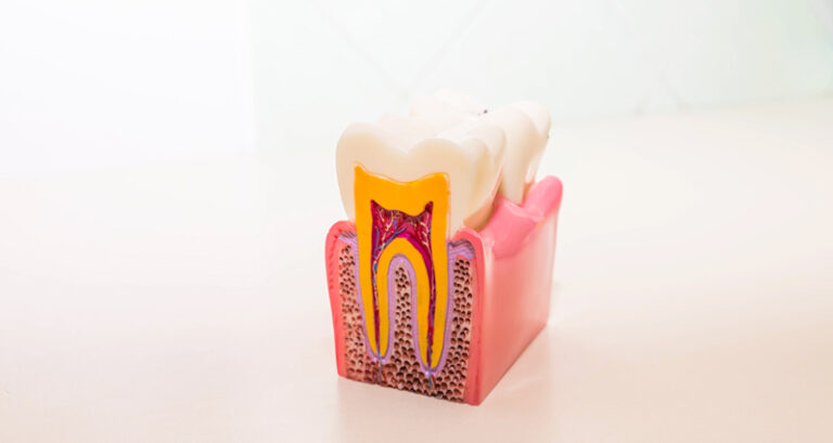 Devitalizzazioni-studio dentistico angelini a grosseto