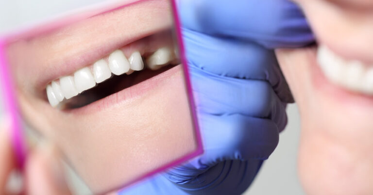 dente-perso-studio dentistico angelini a grosseto