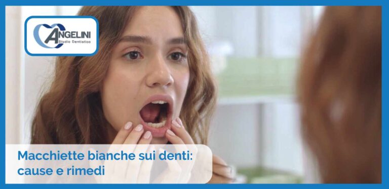 Macchiette bianche sui denti