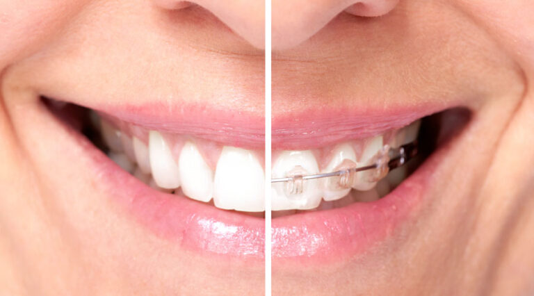 spostare-i-denti-studio dentistico angelini a grosseto